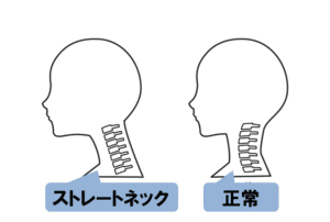 ストレートネック